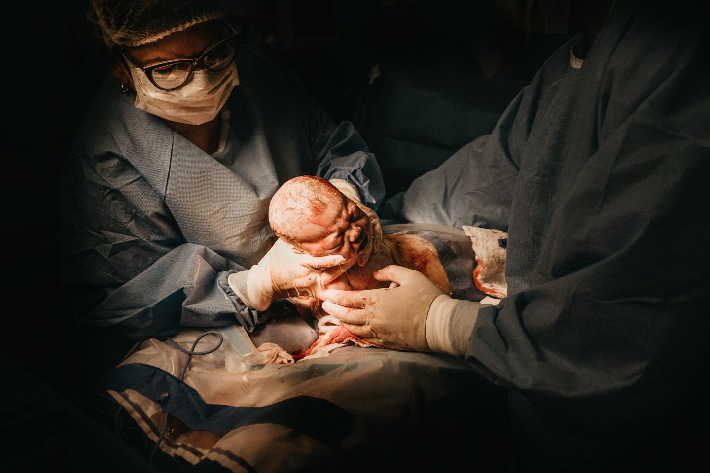 c-section woman giving birth
