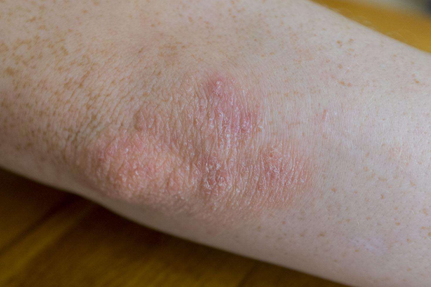psoriasis. on an elbow