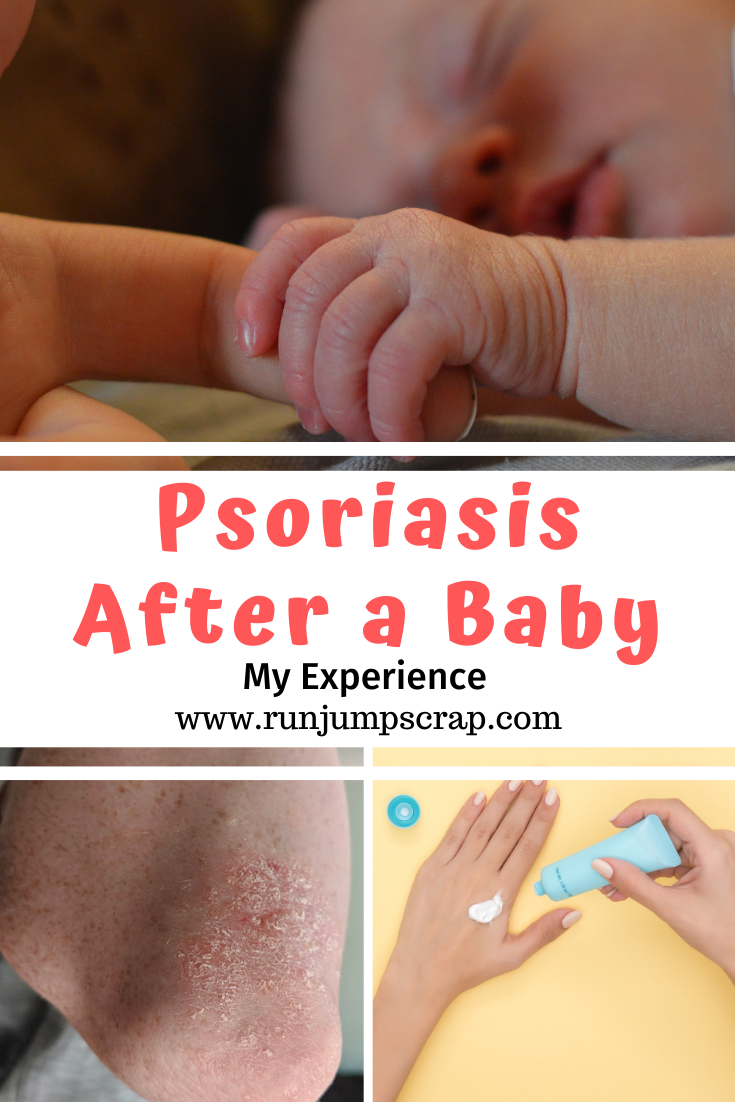 psoriasis after a baby